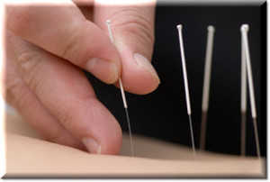 Acupuncture