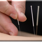 Bring on the Needles – Back to the Acupuncturist